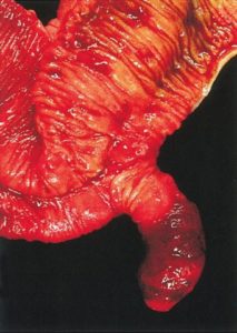 Meckel's diverticulum