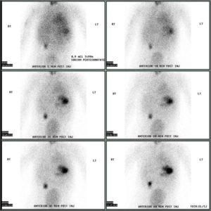 Meckel's diverticulum by technetium 99m pertechnetate scan