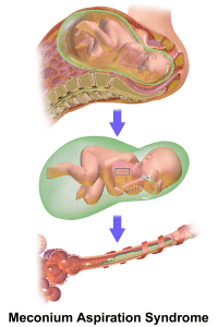 Meconium aspiration syndrome