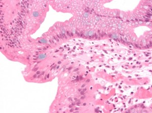 Micrograph of Barrett’s esophagus