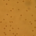 Microscopic hematuria Microscopic hematuria