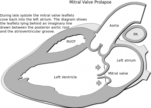 Mitral Valve Prolapse (Barlow Syndrome) — Diagnosis and Treatment