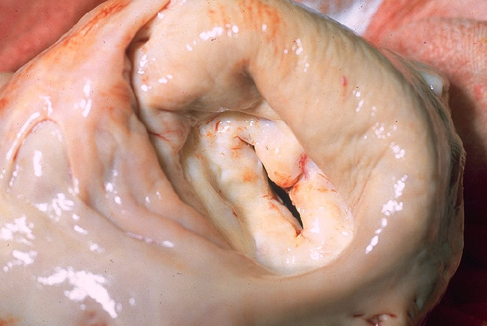 Gross pathology of heart showing mitral stenosis
