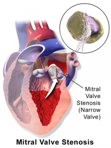 Mitral valve stenosis
