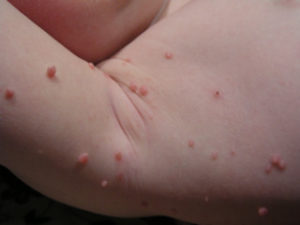 molluscum contagiosum 