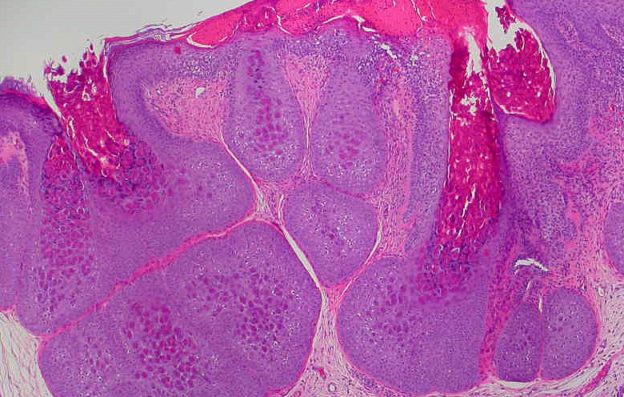 Molluscum Contagiosum