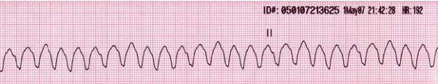 Monomorphic ventricular tachycardia