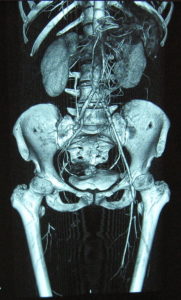 Morbus Buerger, CT angiogram
