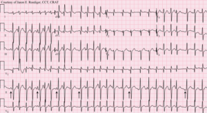 Multifocal atrial tachycardia