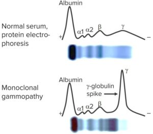 Multiple Myeloma