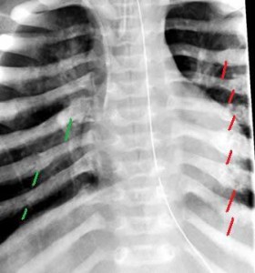Multiple-Rib-Fractures