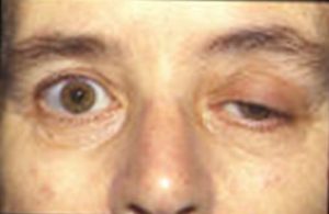 Myasthenia