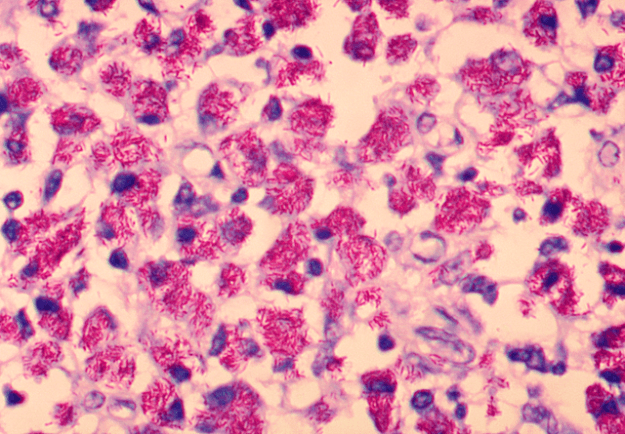 Mycobacterium avium-intracellulare