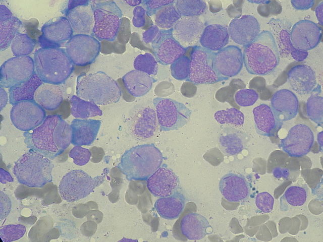 Myeloblast with Auer rod smear