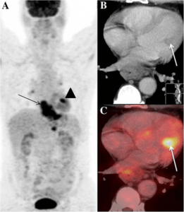 Myocardial metastases from esophageal cancer Myocardial metastases from esophageal cancer
