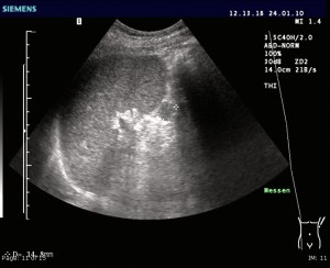 Accessory spleen