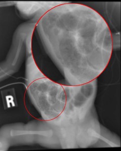 Necrotizing enterocolitis