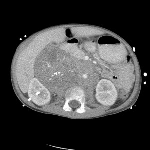 Neuroblastoma-CT-abdoma
