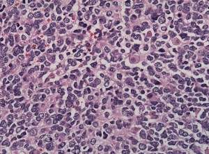 Neuroblastoma_cell_matruration
