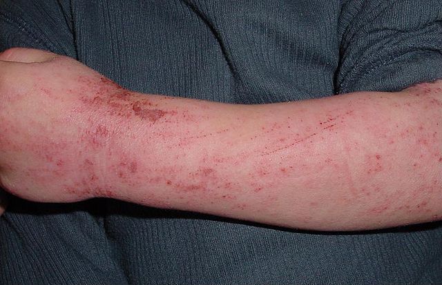 Atopic Eczema Atopic Dermatitis In Children Causes Treatment