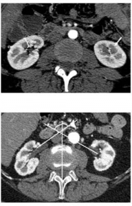  Normal kidney size and its influencing factors