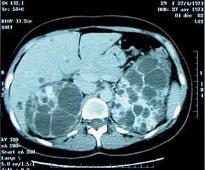“CT of patient with polycystic kidney disease