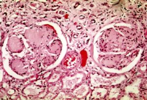 Nodular glomerulosclerosis