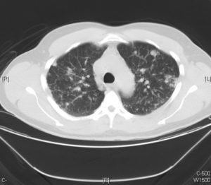 nodular sarcoidosis ct scan