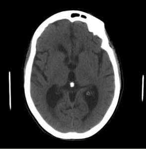 Normal pressure hydrocephalus CT