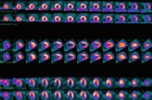 Nuclear medicine myocardial perfusion scan of normal heart muscle