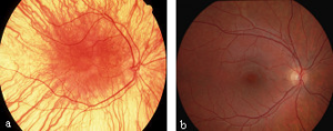 Oculocutaneous albinism