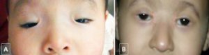 Eye anomalies