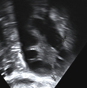polycystic ovary ultrasound