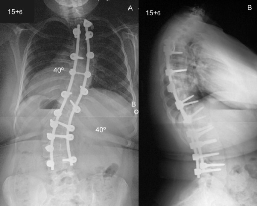 Scoliosis In Children And Osteogenesis Imperfecta (OI) | Medical Library