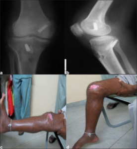 Neglected irreducible posterolateral knee dislocation