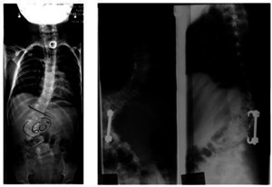 Scoliosis
