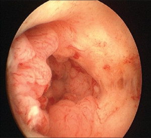 carcinoma endometrium