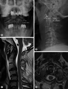 Treatment of an unstable jefferson fracture