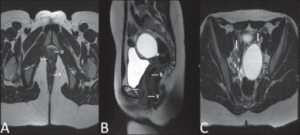 Mayer-Rokitansky-Kuster- Hauser syndrome