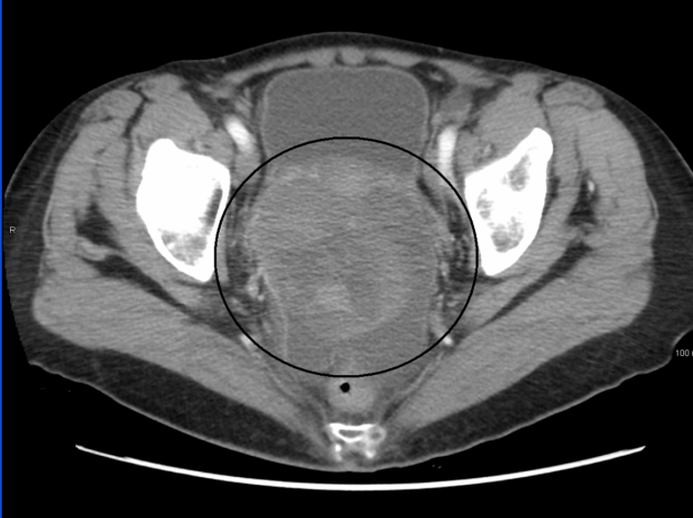 an ovarian cancer as seen on CT