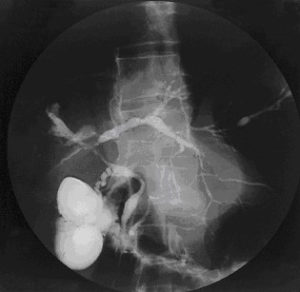 cholangiogram of primary sclerosing cholangitis