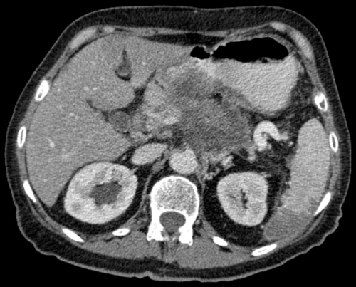 Pancreatic carcinoma Pancreatic carcinoma