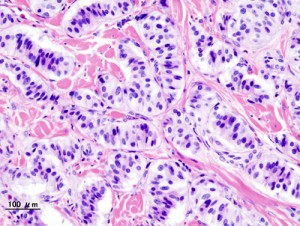Pancreatic-insulinoma