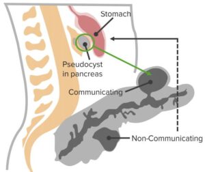 Pancreativ Pseudocyst