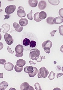 Pelger-Huet cell in the center with two lobed nucleus and decrease cytoplasmic granules Pelger-Huet cell in the center with two lobed nucleus and decrease cytoplasmic granules