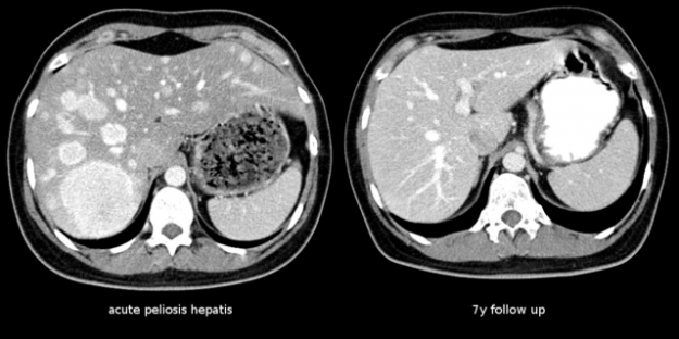 Peliosis hepatis