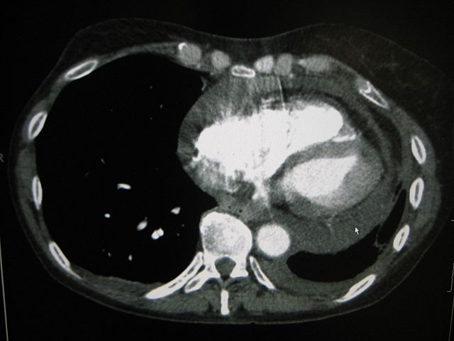 Pericardial effusion CT scan