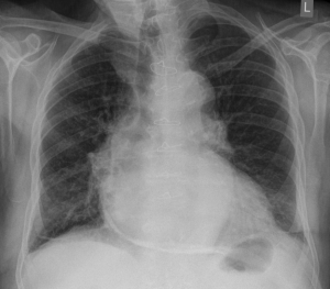 Pericarditis calcarea x-ray