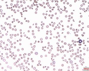 Peripheral blood smear – patient with thrombotic thrombocytopenic purpura