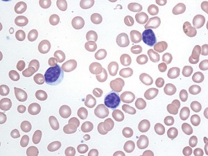 Peripheral blood with chronic lymphocytic leukemia